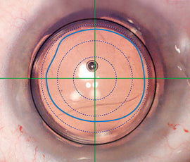 HumanOptics ASPIRA